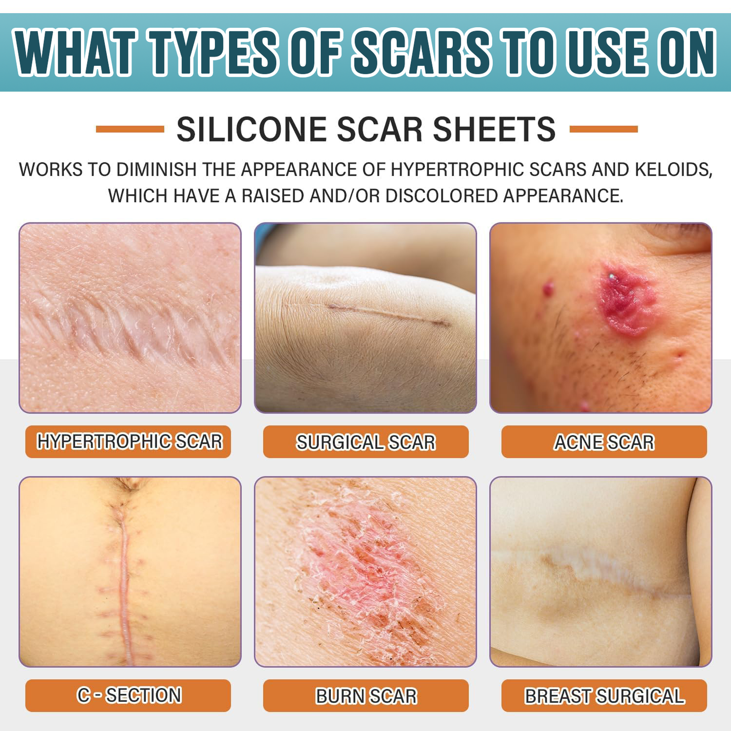 Icystar®Tranexamic Acid silicone scar sheets——Fade Scars · Brighten Dark Spots · Firm Loose Skin