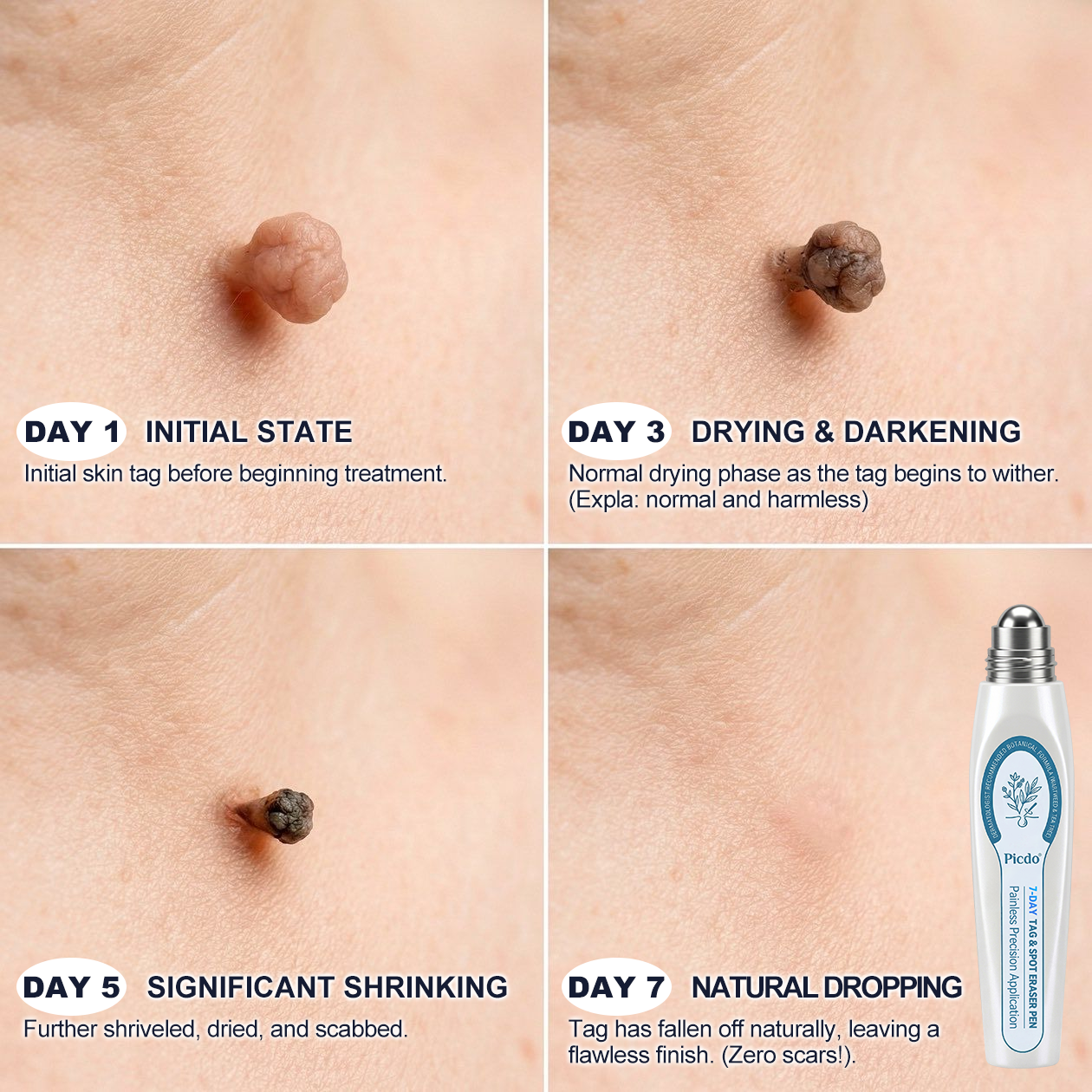 ICYSTAR® 7-𝐷𝑎𝑦 𝗧𝐚𝐠 & 𝗦𝗽𝐨𝐭 𝐄𝐫𝒂𝒔𝒆𝒓✅🚀(Zero Pain, Zero 𝐒𝐜𝐚𝒓𝒔 Rollerball)