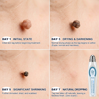 ICYSTAR® 7-𝐷𝑎𝑦 𝗧𝐚𝐠 & 𝗦𝗽𝐨𝐭 𝐄𝐫𝒂𝒔𝒆𝒓✅🚀(Zero Pain, Zero 𝐒𝐜𝐚𝒓𝒔 Rollerball)